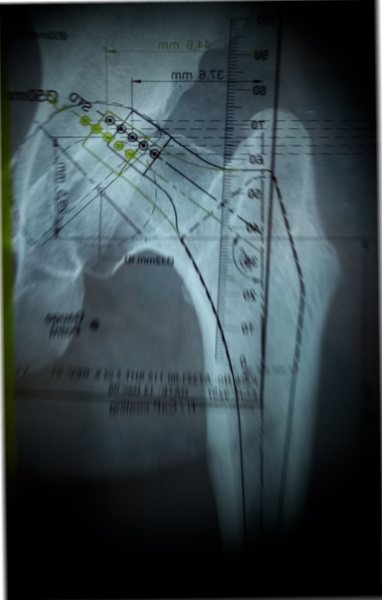 Il Planning Preoperatorio